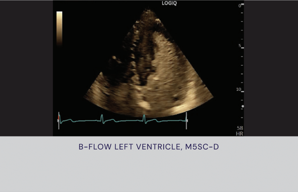 LOGIQ Fortis B-Flow Left Ventricle